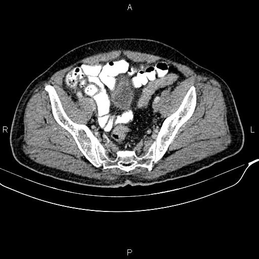 File:Cecal cancer with appendiceal mucocele (Radiopaedia 91080-108651 B 87).jpg
