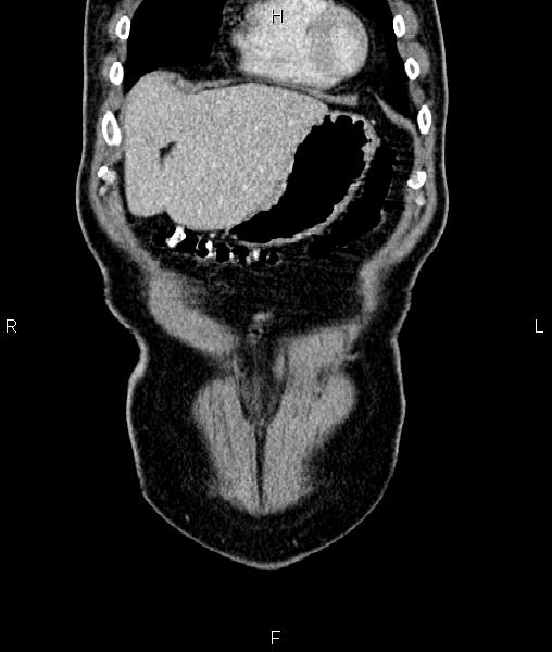 File:Cecal cancer with appendiceal mucocele (Radiopaedia 91080-108651 D 10).jpg