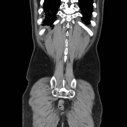 Cecal mass causing appendicitis (Radiopaedia 59207-66531 B 47).jpg