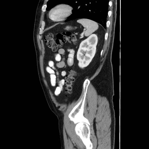 Cecal mass causing appendicitis (Radiopaedia 59207-66531 C 51).jpg