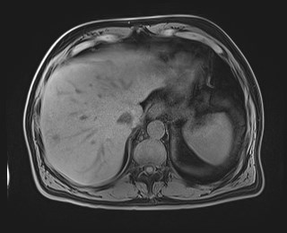 Cecal mass causing appendicitis (Radiopaedia 59207-66532 Axial T1 29).jpg