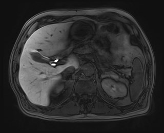 Cecal mass causing appendicitis (Radiopaedia 59207-66532 K 40).jpg