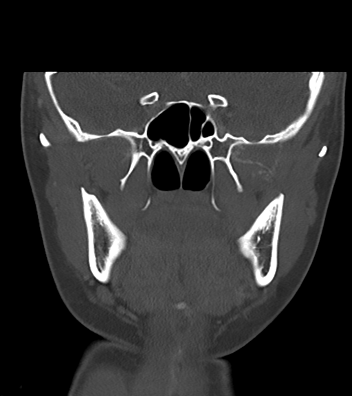 Cemento-ossifying fibroma (Radiopaedia 46243-50643 Coronal bone window 30).png