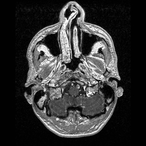 Central-variant posterior reversible encephalopathy syndrome (PRES) (Radiopaedia 43880-47358 Axial T1 C+ 8).jpg