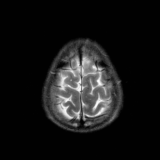 File:Central-variant posterior reversible encephalopathy syndrome (PRES) (Radiopaedia 43880-47359 Axial T2 22).jpg