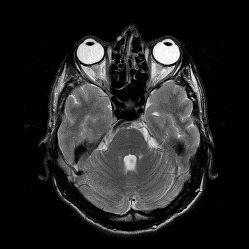 File:Central-variant posterior reversible encephalopathy syndrome (PRES) (Radiopaedia 43880-47359 Axial T2 6).jpg