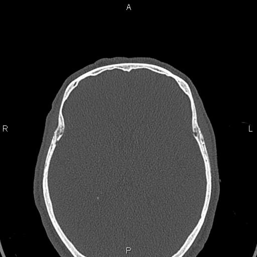 File:Central giant cell granuloma (Radiopaedia 83346-97761 Axial bone window 83).jpg
