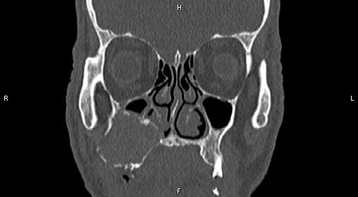 File:Central giant cell granuloma (Radiopaedia 83346-97761 Coronal bone window 12).jpg
