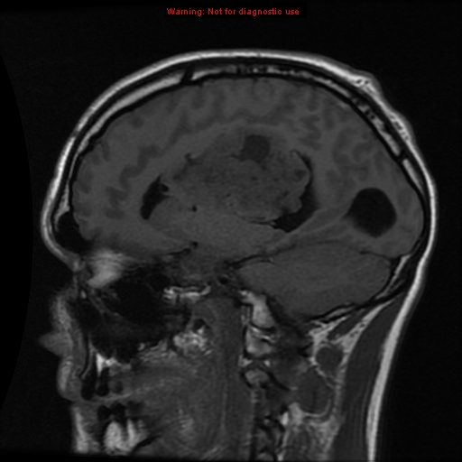 File:Central neurocytoma (Radiopaedia 13188-13206 Sagittal T1 6).jpg