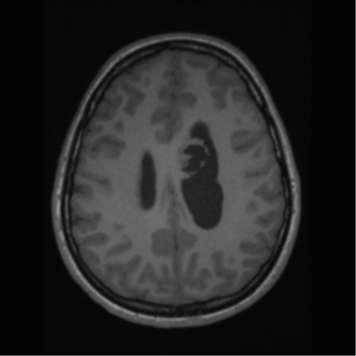 File:Central neurocytoma (Radiopaedia 37664-39557 Axial T1 51).png