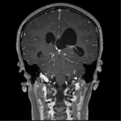 Central neurocytoma (Radiopaedia 37664-39557 Coronal T1 C+ 35).png
