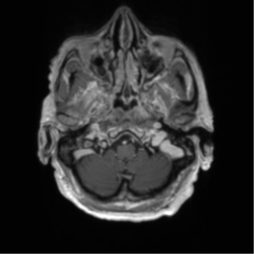Central neurocytoma (Radiopaedia 65317-74345 Axial T1 C+ 1).png