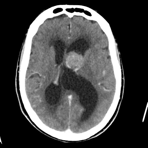 Central neurocytoma (Radiopaedia 65317-74346 Axial C+ delayed 27).png