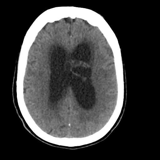 Central neurocytoma (Radiopaedia 65317-74346 Axial non-contrast 32).png