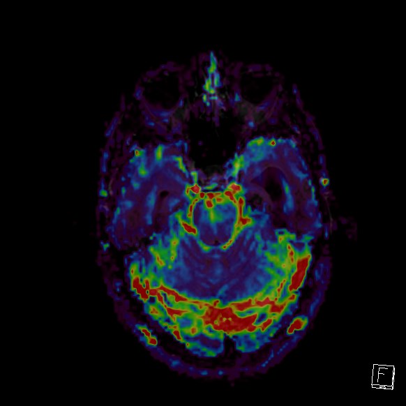 Central neurocytoma (Radiopaedia 84497-99872 Axial Perfusion 229).jpg