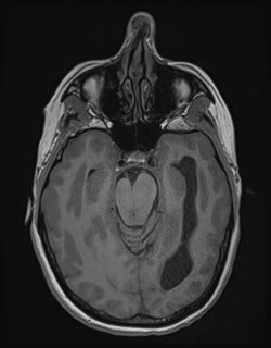 Central neurocytoma (Radiopaedia 84497-99872 Axial T1 75).jpg