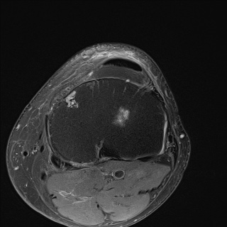 File:Central osteophyte (Radiopaedia 72592-83151 Axial PD fat sat 25).jpg