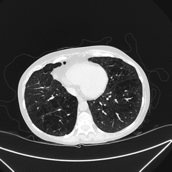 Centrilobular pulmonary emphysema (Radiopaedia 24495-24789 Axial lung window 69).jpg