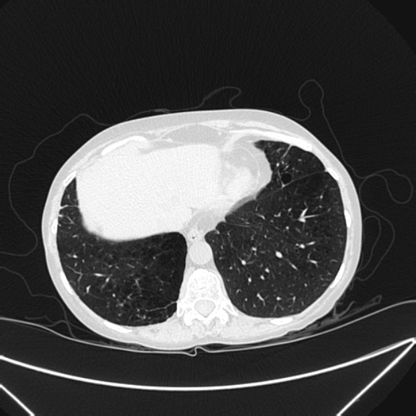 Centrilobular pulmonary emphysema (Radiopaedia 24495-24789 Axial lung window 77).jpg