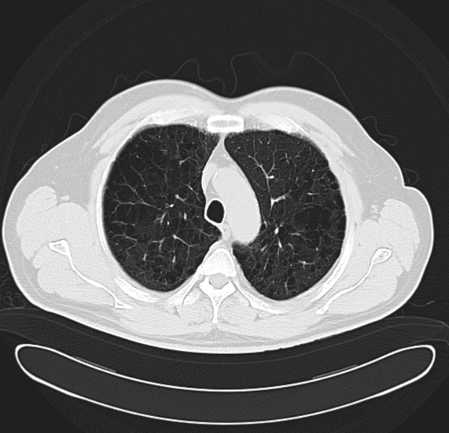Centrilobular pulmonary emphysema (Radiopaedia 26808-26971 C 11).jpg