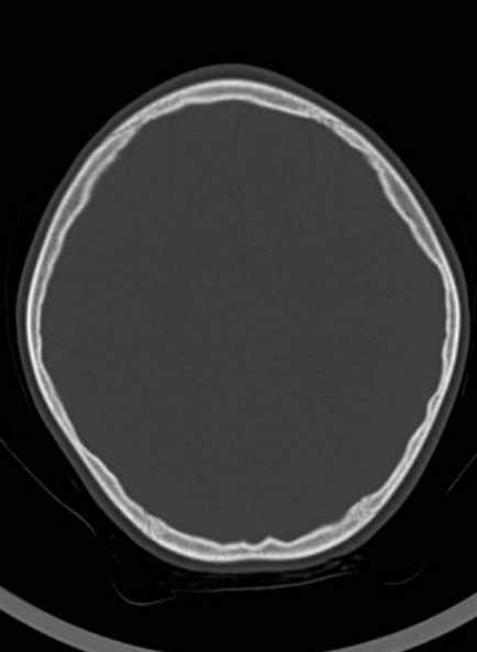 Cerebellar abscess (Radiopaedia 73727-84527 Axial bone window 49).jpg