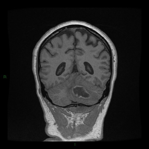 Cerebellar abscess (Radiopaedia 78135-90678 Coronal T1 C+ 119).jpg