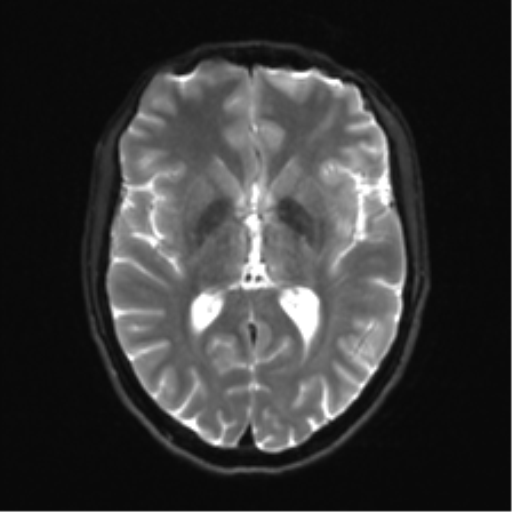 Cerebellar agenesis with hypoplastic pons (pontocerebellar hypoplasia) (Radiopaedia 57224-64138 Axial DWI 20).png
