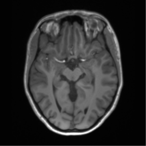 Cerebellar agenesis with hypoplastic pons (pontocerebellar hypoplasia) (Radiopaedia 57224-64138 Axial T1 34).png