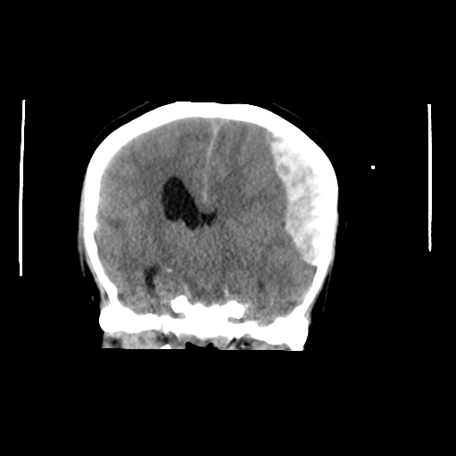 File:Cerebellar ependymoma complicated by post-operative subdural hematoma (Radiopaedia 83322-97737 Axial non-contrast 1).png