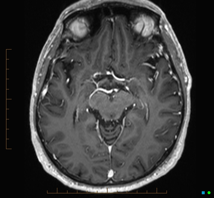 Cerebellar gangliocytoma (Radiopaedia 65377-74422 Axial T1 C+ 54).jpg