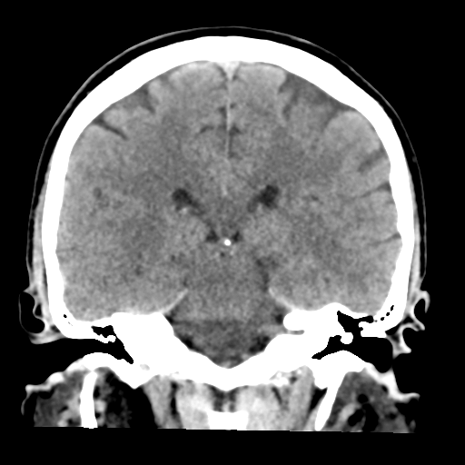 File:Cerebellar hemorrhage (Radiopaedia 37000-38669 Coronal non-contrast 28).png
