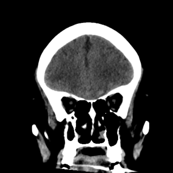Cerebellar hemorrhage causing obstructive hydrocephalus (Radiopaedia 33989-35207 Coronal non-contrast 16).jpg