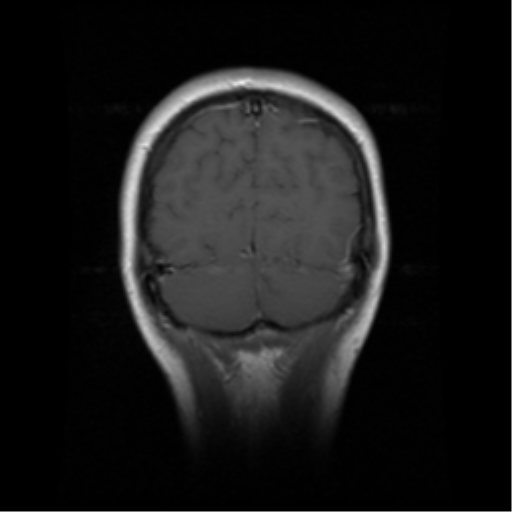 File:Cerebellar metastases - colorectal adenocarcinoma (Radiopaedia 40947-43655 Coronal T1 C+ 5).png