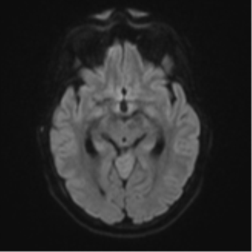 Cerebellar metastasis (Radiopaedia 51137-56765 Axial DWI 41).png