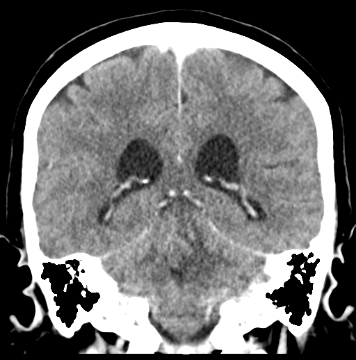 Cerebellar metastasis (Radiopaedia 54578-60812 Coronal C+ 38).png
