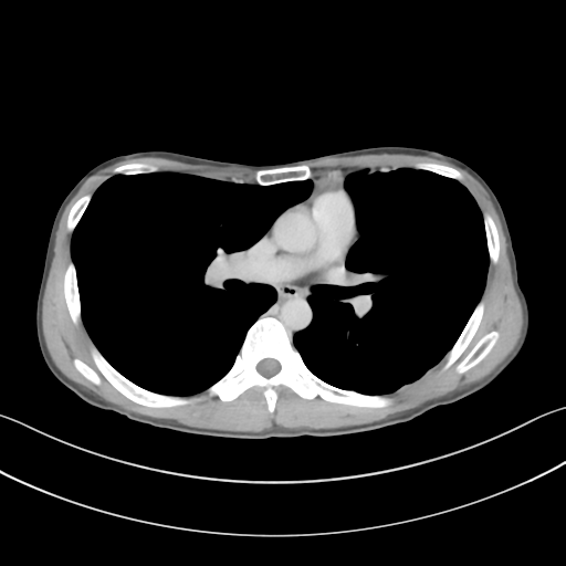 File:Cerebellar metastasis - adenocarcinoma lung (Radiopaedia 63184-71717 Axial C+ delayed 33).png