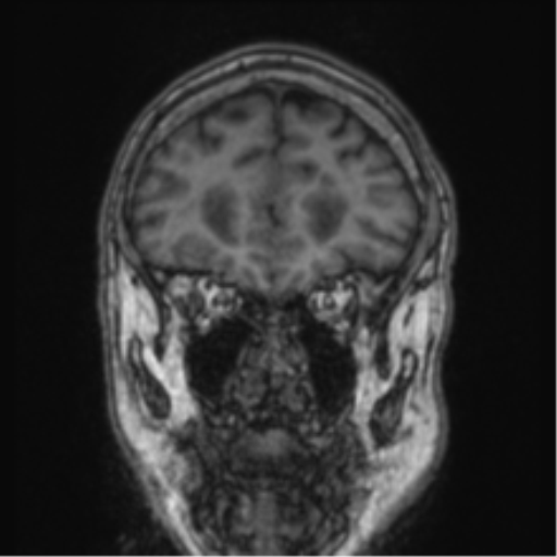 Cerebellar metastasis from lung adenocarcinoma (Radiopaedia 86690-102829 Coronal T1 77).png