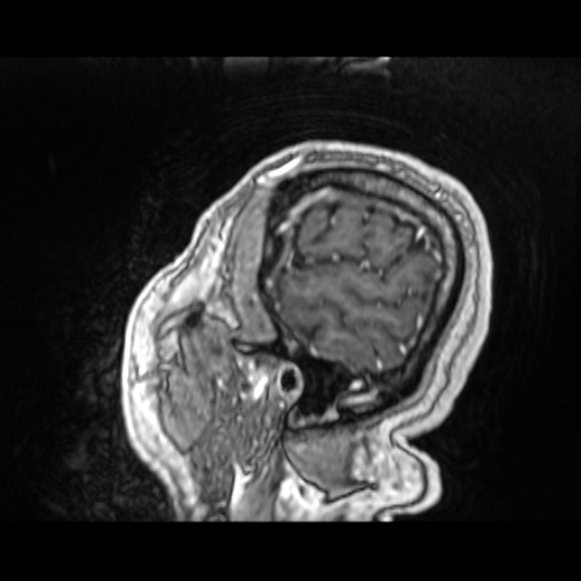 Cerebellar metastasis of pulmonary adenocarcinoma, cavernous venous malformation, and developmental venous anomaly (Radiopaedia 85827-101661 Sagittal T1 C+ 81).jpg