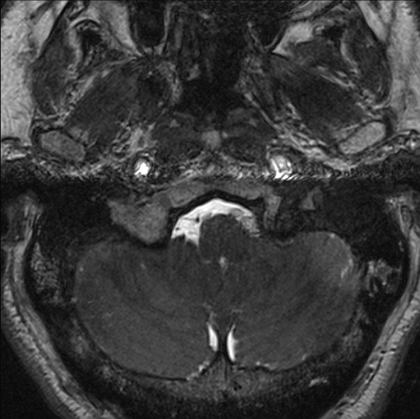 Cerebellopontine angle meningioma (Radiopaedia 24459-24764 I 7).jpg