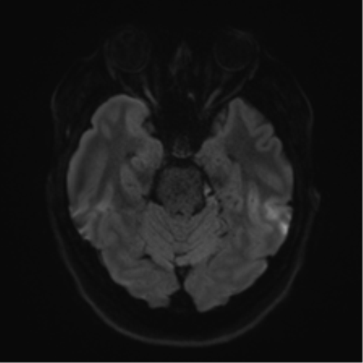 Cerebellopontine angle meningioma (Radiopaedia 48434-53348 Axial DWI 49).png