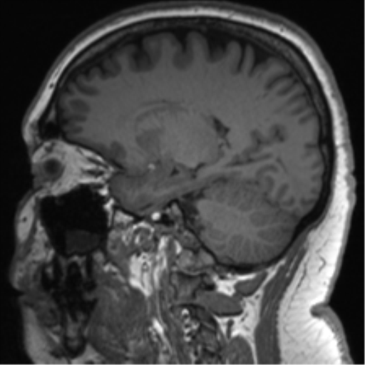 Cerebellopontine angle meningioma (Radiopaedia 48434-53348 Sagittal T1 57).png