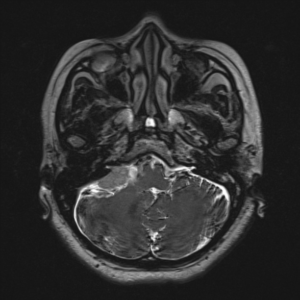 Cerebellopontine angle meningioma (Radiopaedia 53561-59591 Axial 3D volume T2 44).jpg
