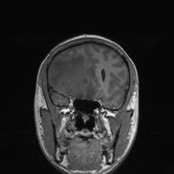 Cerebral abscess (Radiopaedia 24212-24478 Coronal T1 76).jpg