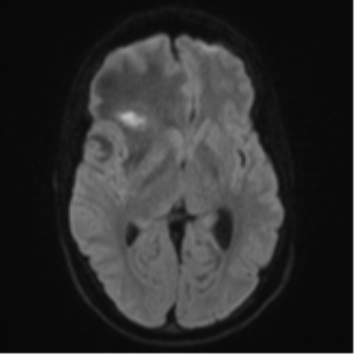 Cerebral abscess (Radiopaedia 60342-68009 Axial DWI 53).png