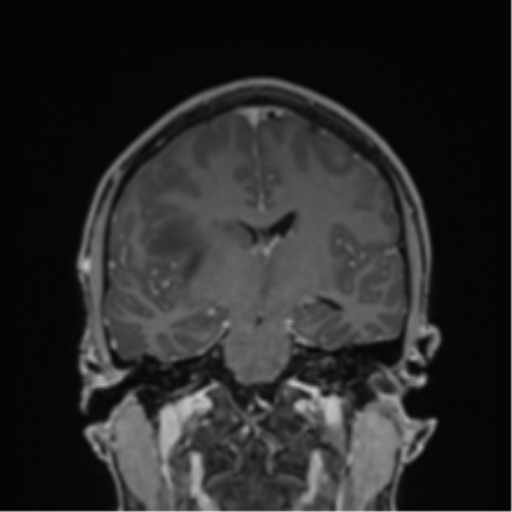 Cerebral abscess (Radiopaedia 60342-68009 H 24).png
