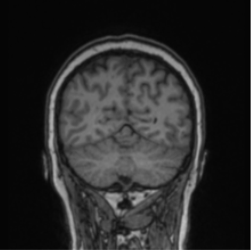 Cerebral abscess from pulmonary arteriovenous malformation (Radiopaedia 86275-102291 Coronal T1 25).png
