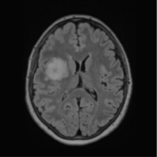 Cerebral abscess from pulmonary arteriovenous malformation (Radiopaedia 86275-102291 J 44).png