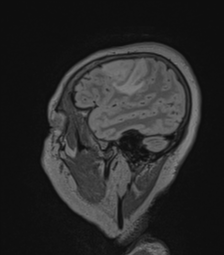 Cerebral abscess from pulmonary arteriovenous malformation (Radiopaedia 86275-102291 Sagittal FLAIR 61).png