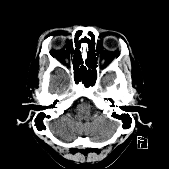 File:Cerebral abscess with ventriculitis (Radiopaedia 78965-91877 A 10).jpg