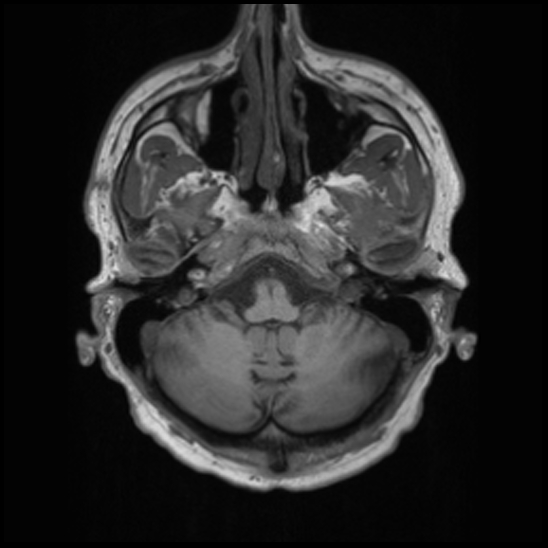 File:Cerebral abscess with ventriculitis (Radiopaedia 78965-91878 Axial T1 9).jpg
